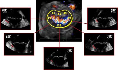 Mapping of the myxomatous mitral valve: The three-dimensional extension of mitral annular disjunction in surgically repaired mitral prolapse